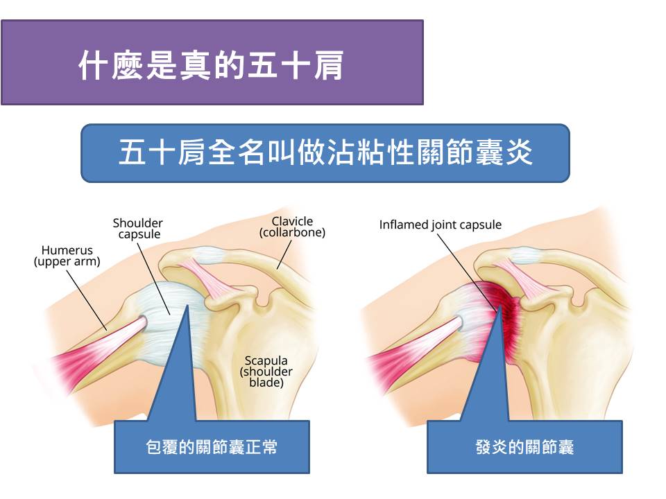 五十肩形成的原因