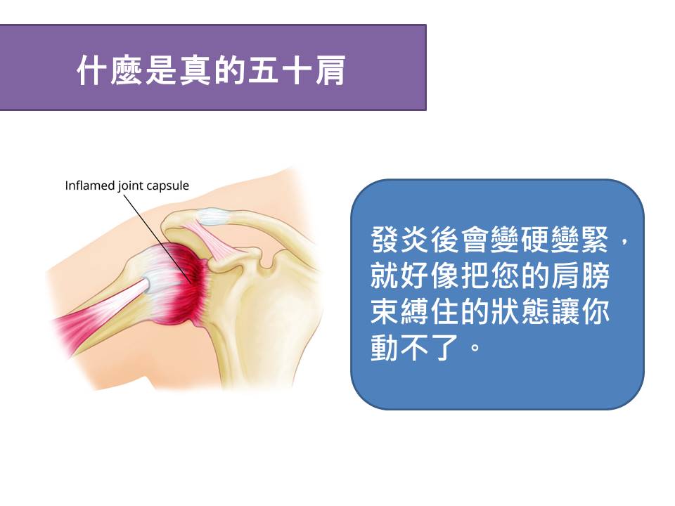 五十肩形成後的狀態