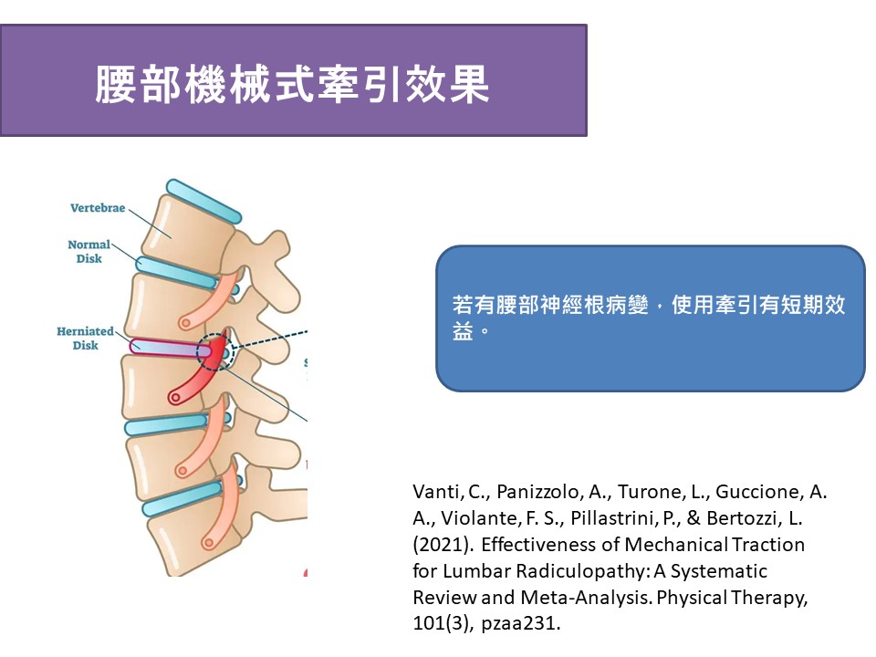 圖片說明：機械牽引對於神經根病變的效果