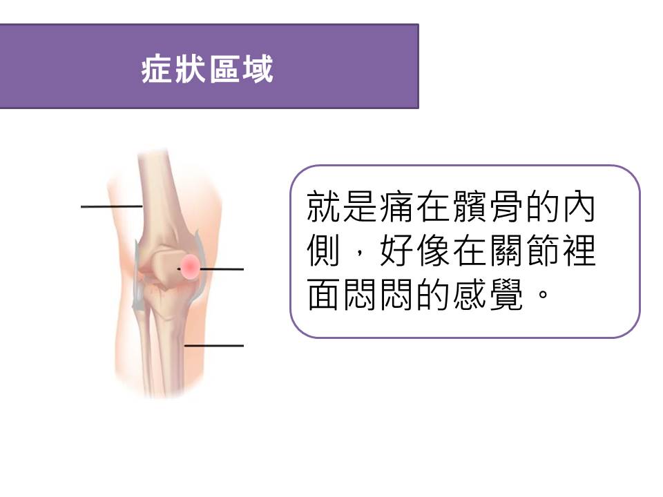 髕骨股骨症候群狀態