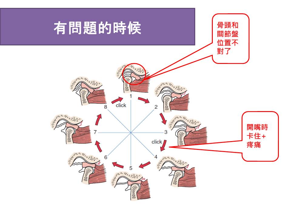 圖片說明：顳顎關節卡住時的結構圖