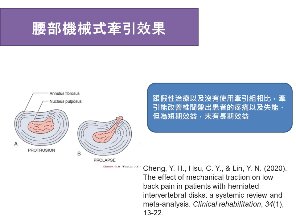 圖片說明：椎間盤突出使用機械牽引的效果