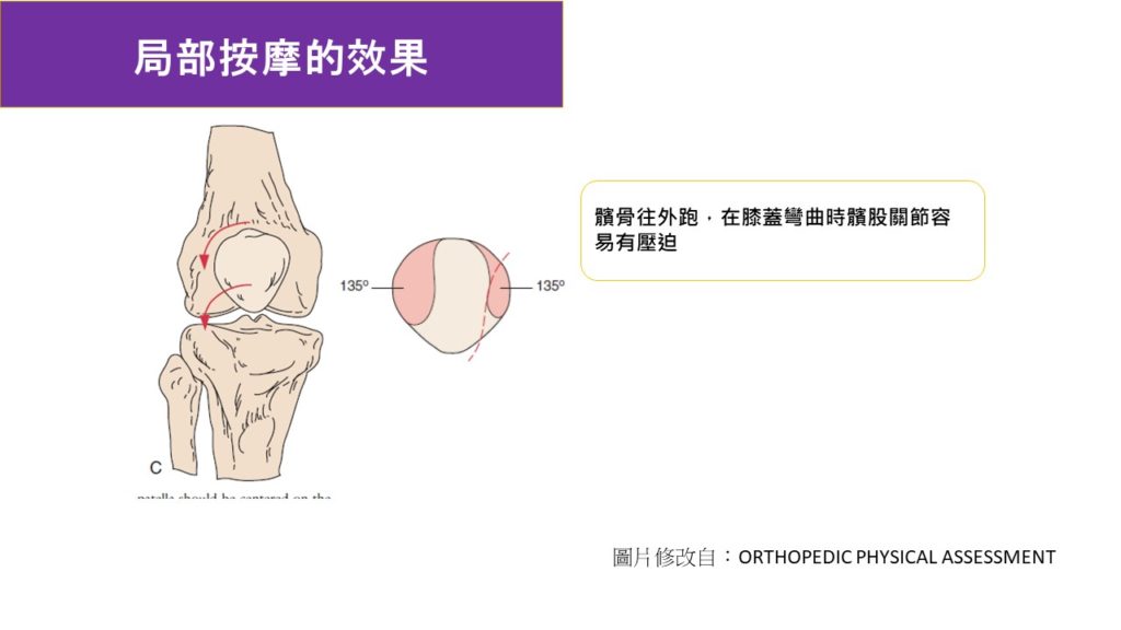 髕骨外移的情況