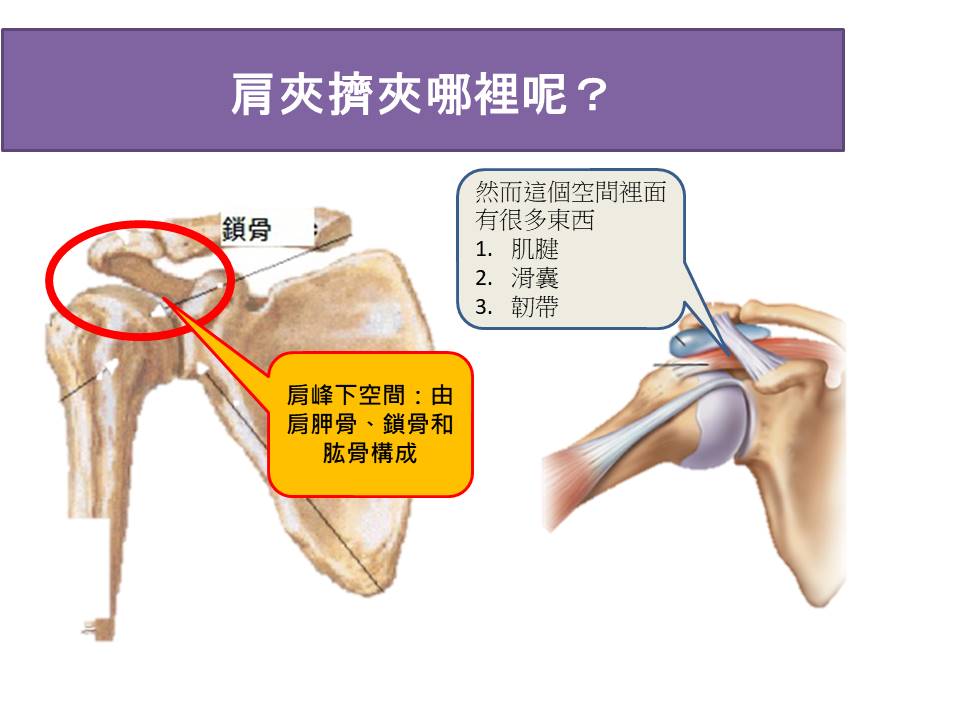 肩夾擠症候群在哪邊發生