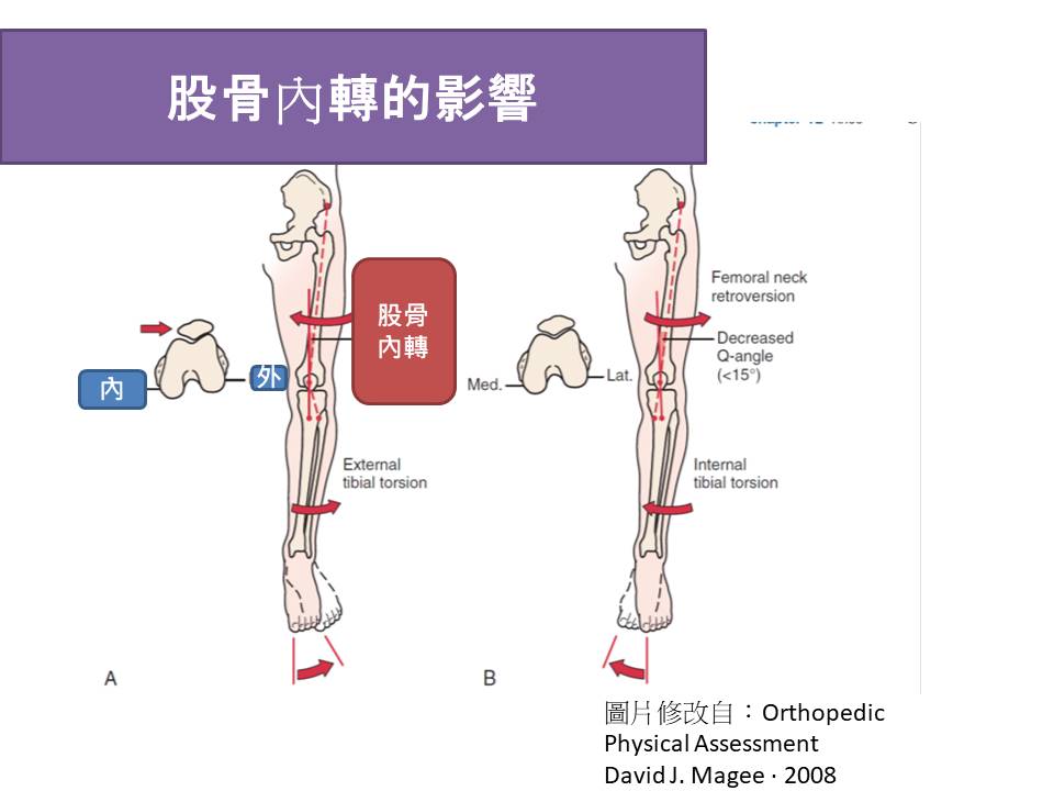 股骨內轉對於髕骨的影響