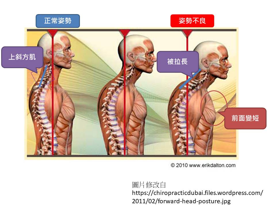 姿勢不良肌肉變化圖