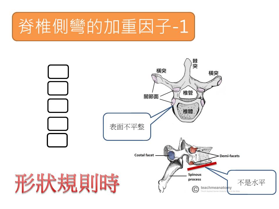 脊椎側彎1